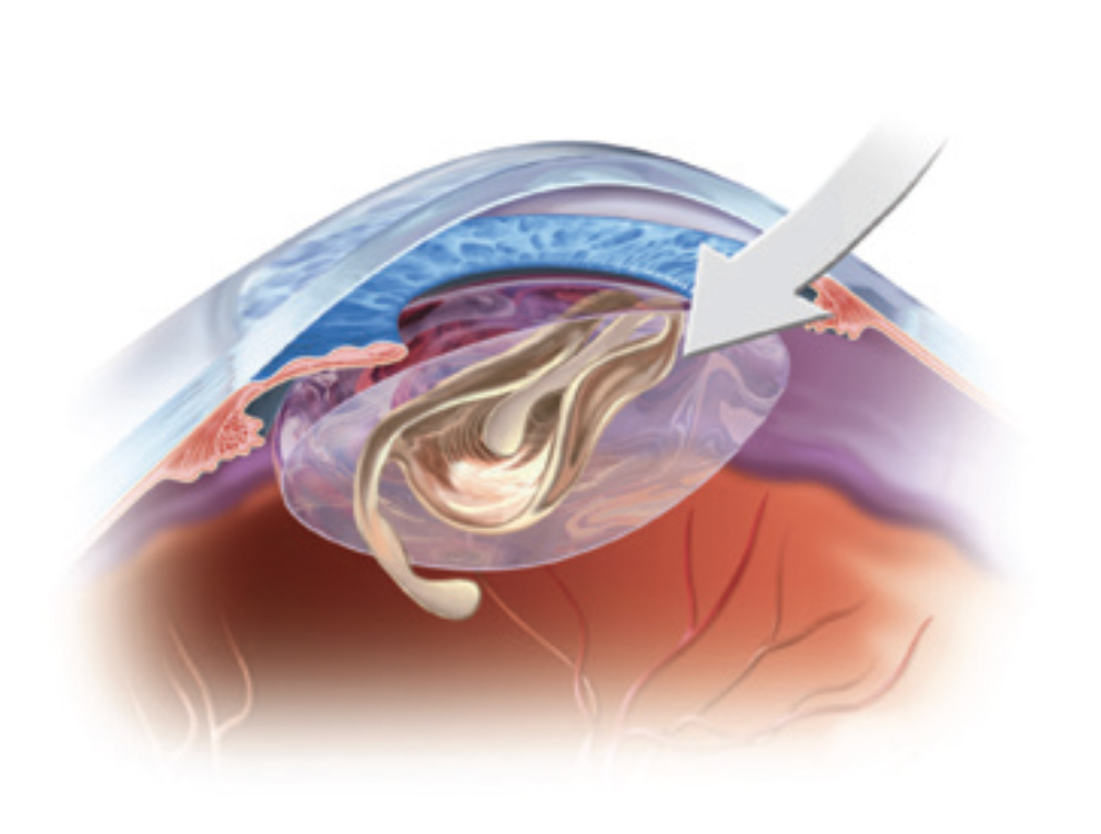 Lens insertion